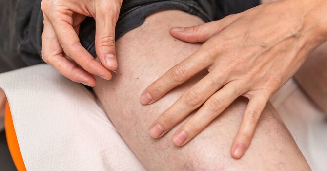 Acupuncture & Dry Needling/IMS